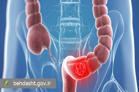 نشستن طولانی، خطر ابتلا به سرطان روده بزرگ را افزایش می‌دهد