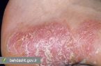 در بیماری پسوریازیس خوددرمانی ممنوع