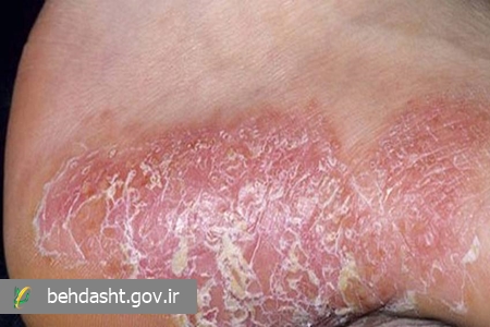 در بیماری پسوریازیس خوددرمانی ممنوع
